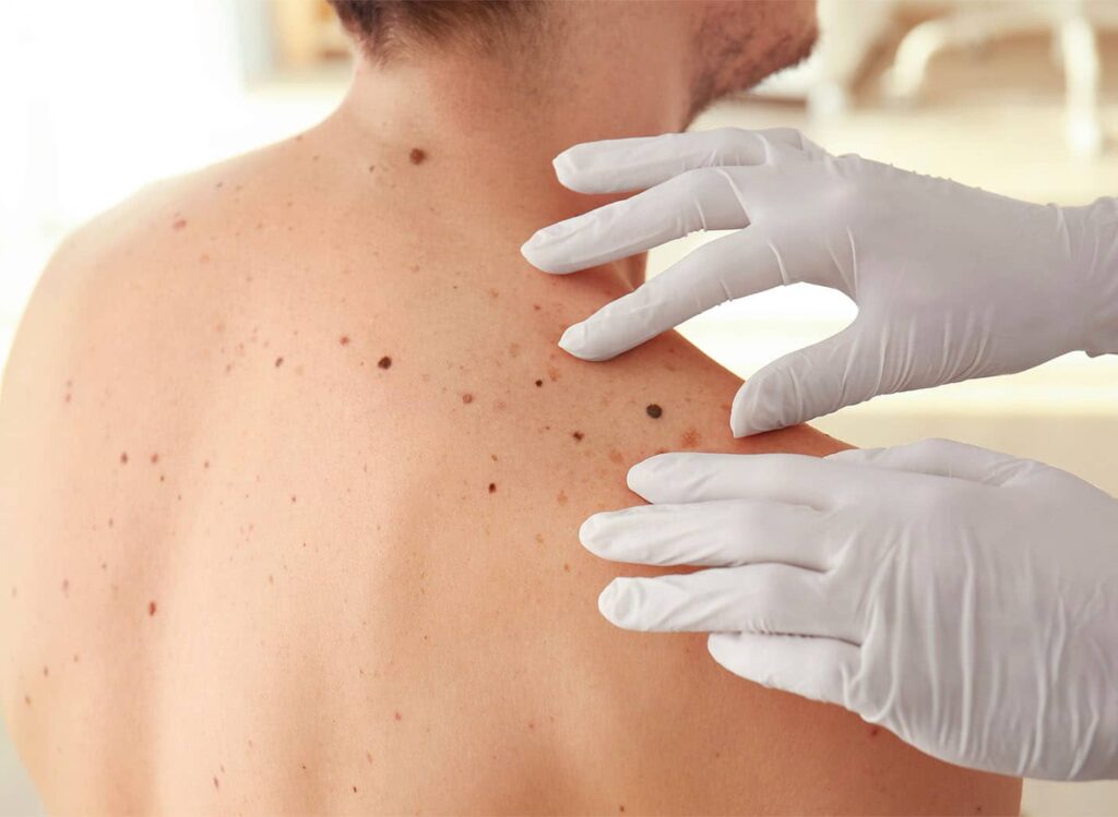 Cancer De La Peau Causes Centre De Chirurgie Dermatologique Paris