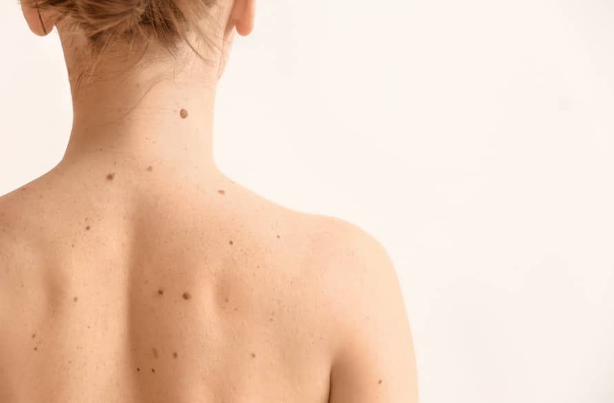 Quels sont les différents types de mélanomes | Centre chirurgie dermatologique | Paris