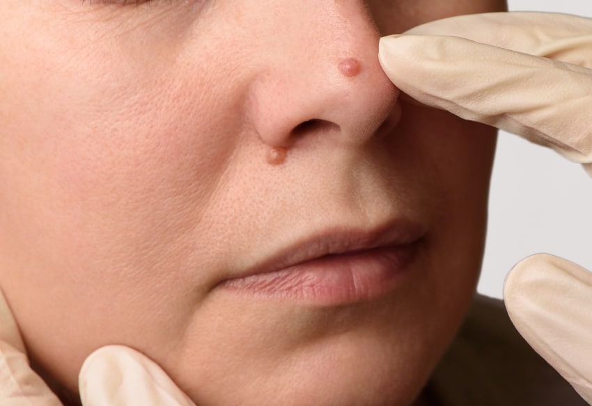 Comment retirer un carcinome sur le nez ?| Centre chirurgie dermatologique | Paris