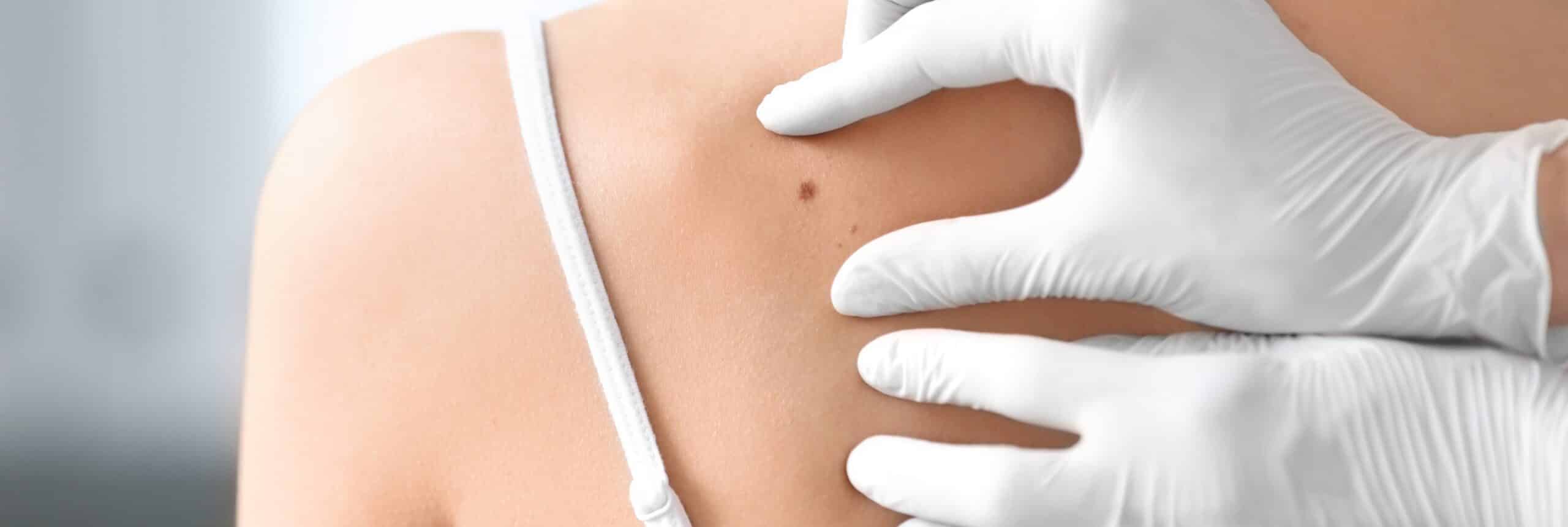 Retrait de grain de beauté : quelle prise en charge ? | Centre chirurgie dermatologique | Paris